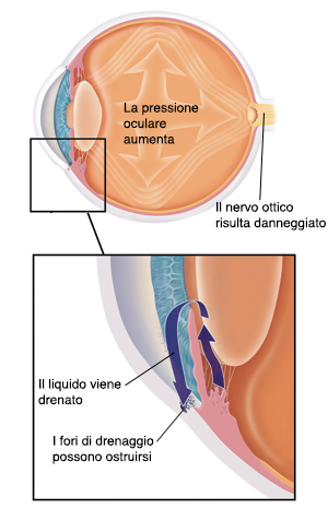 Vista laterale dell’occhio con frecce all’interno che mostrano l’aumento della pressione. Il nervo ottico nella parte posteriore dell’occhio è danneggiato. Primo piano della sezione trasversale dell’occhio dove la cornea copre l’iride. La pupilla si apre al centro dell’iride. Il cristallino è dietro l’iride. Il fluido fuoriesce da dietro l’iride attraverso la pupilla fino alla parte anteriore dell’iride. Il fluido quindi defluisce dall’occhio attraverso i fori vicino alla cornea. I fori di drenaggio possono ostruirsi.