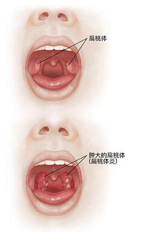 口腔张开时面部的前视图,对比正常的口腔和扁桃体与发炎的喉咙和肿大的扁桃体。