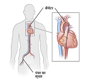 कमर में धमनी में डाला गया कैथेटर दर्शाते हुए आदमी का सामने का दृश्य। इनसेट में हृदय में कैथेटर दिखाया गया है।