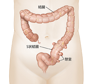 下部に憩室がある結腸の正面図。