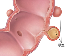 憩室炎を示すS状結腸の断面図。