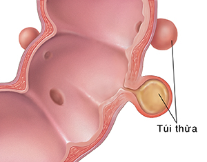 Mặt cắt ngang của đại tràng sigma thể hiện diverticulitis.