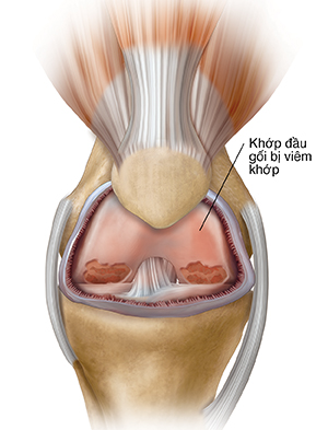 Mặt trước của khớp gối cho thấy tình trạng viêm và viêm khớp.