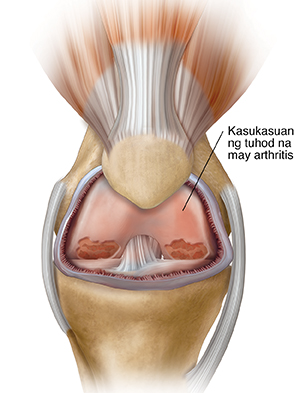 Harapang kuha ng kasukasuan ng tuhod na ipinakikita ang pamamaga at arthritis.